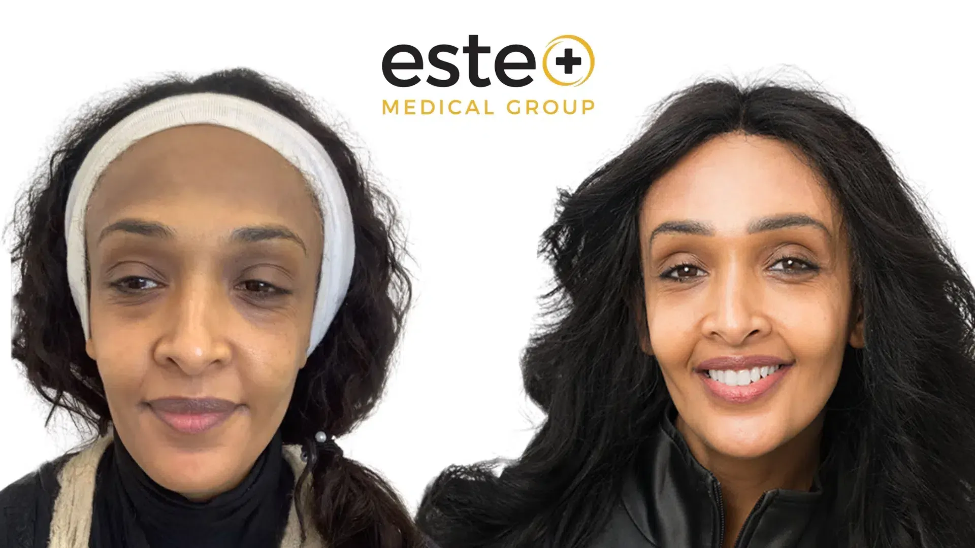 Pigmentation before and after comparison (Cosmelan)