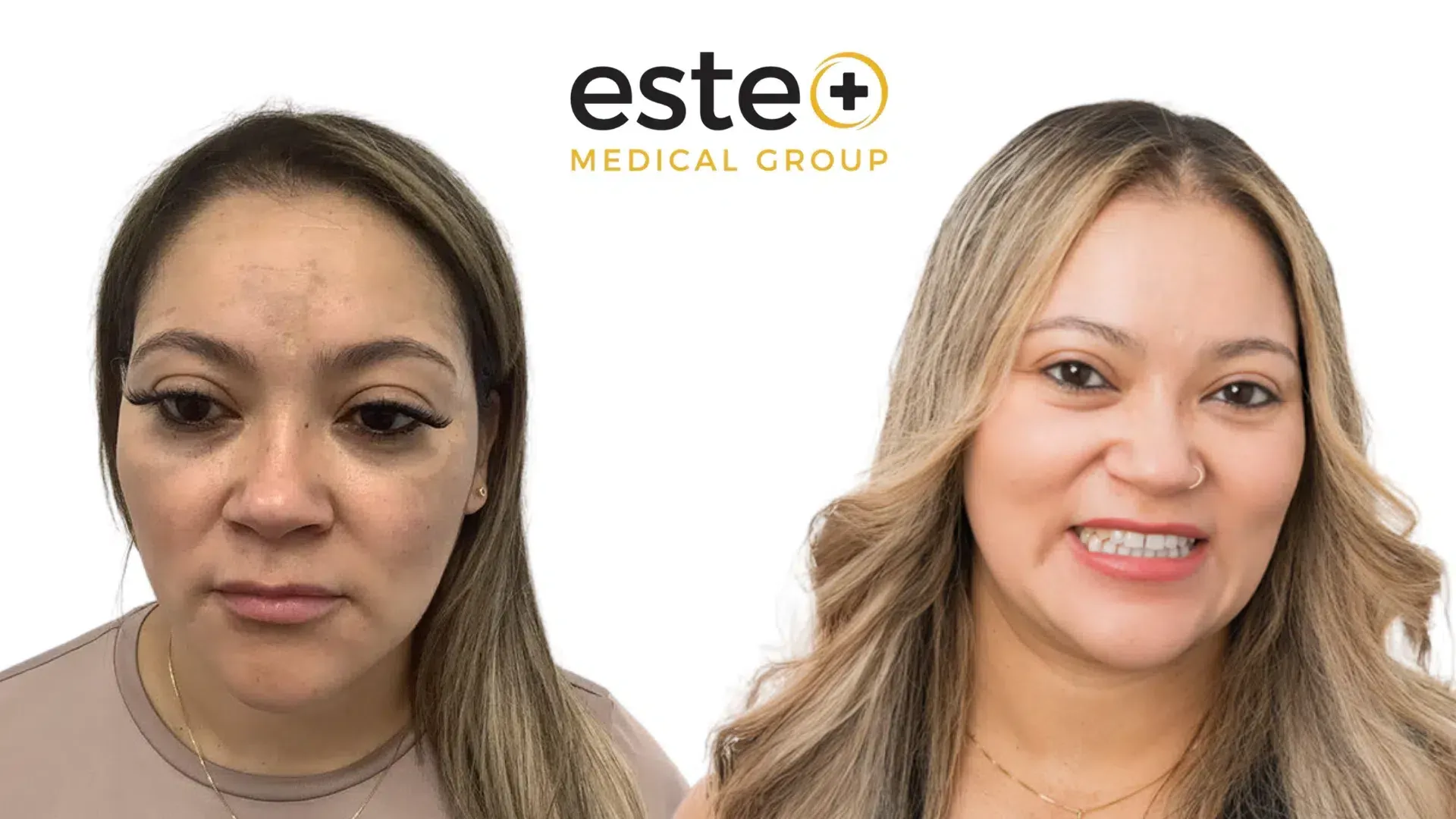 Before and after pigmentation results (Cosmelan)