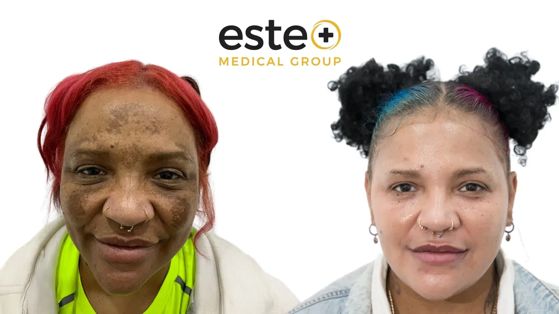 Hyperpigmentation before and after results (Cosmelan)
