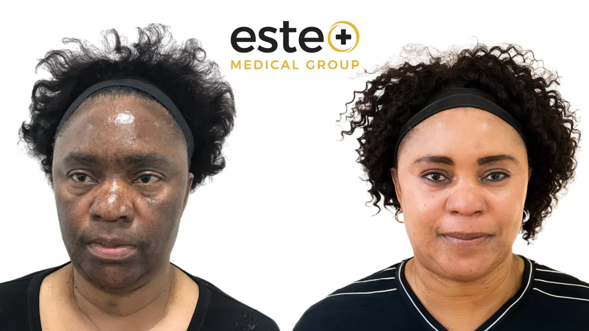 Dark spots before and after results (Cosmelan)