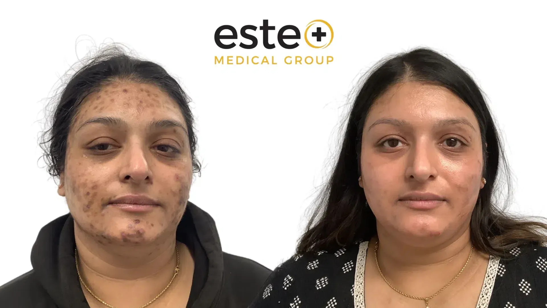 Uneven skin tone before and after results (Cosmelan)