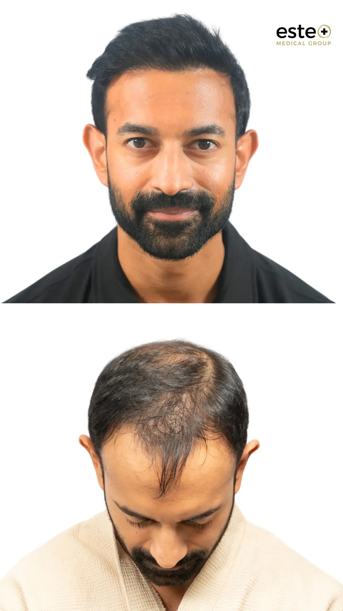 Robotic DHI hair transplant before and after photos