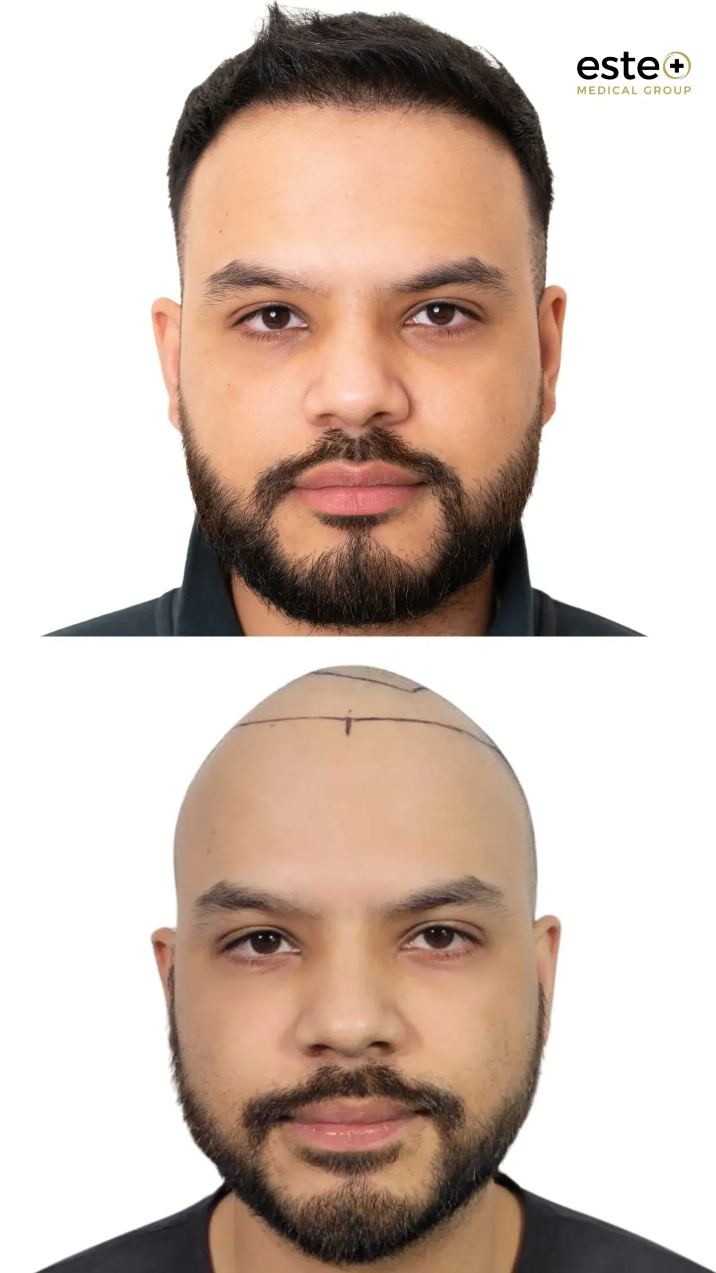 Hair transplant before and after results (patient outcome)