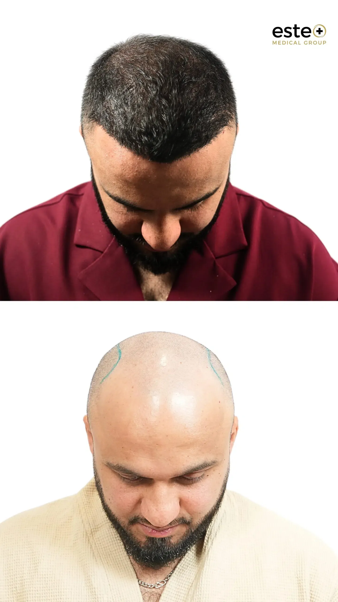 Hair transplant before and after results (patient outcome)