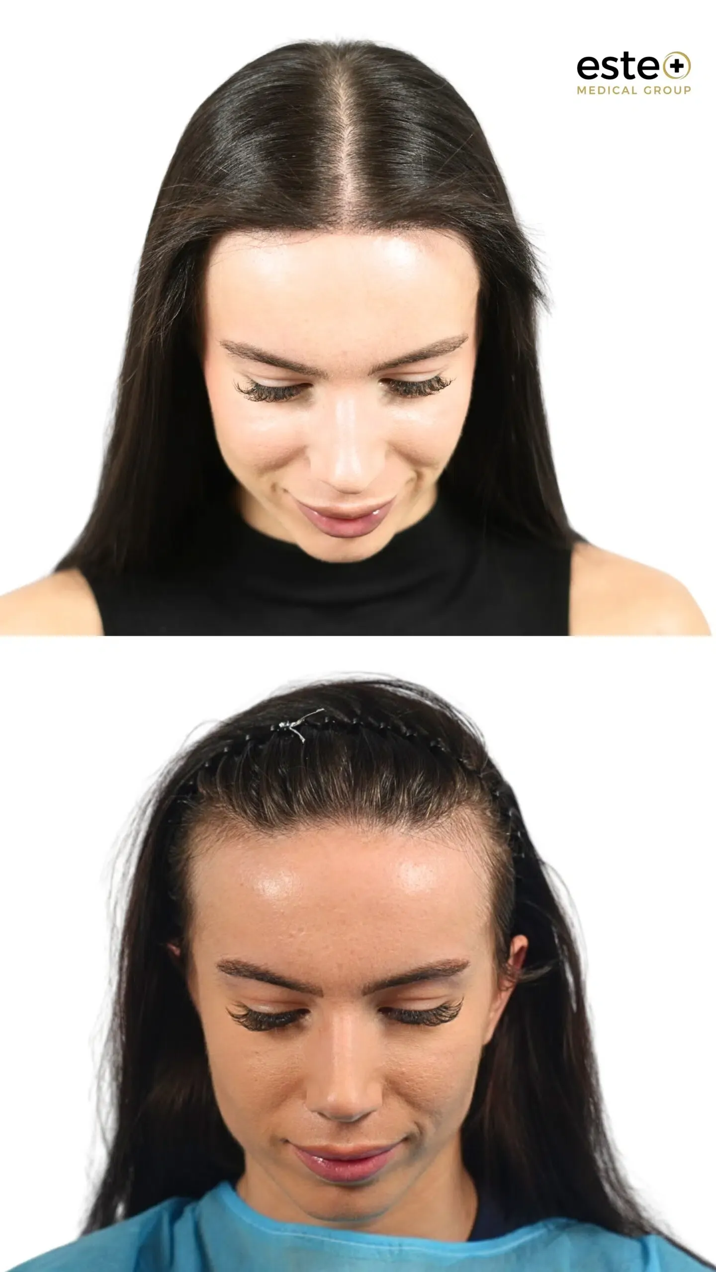 Robotic DHI hair transplant before and after photos