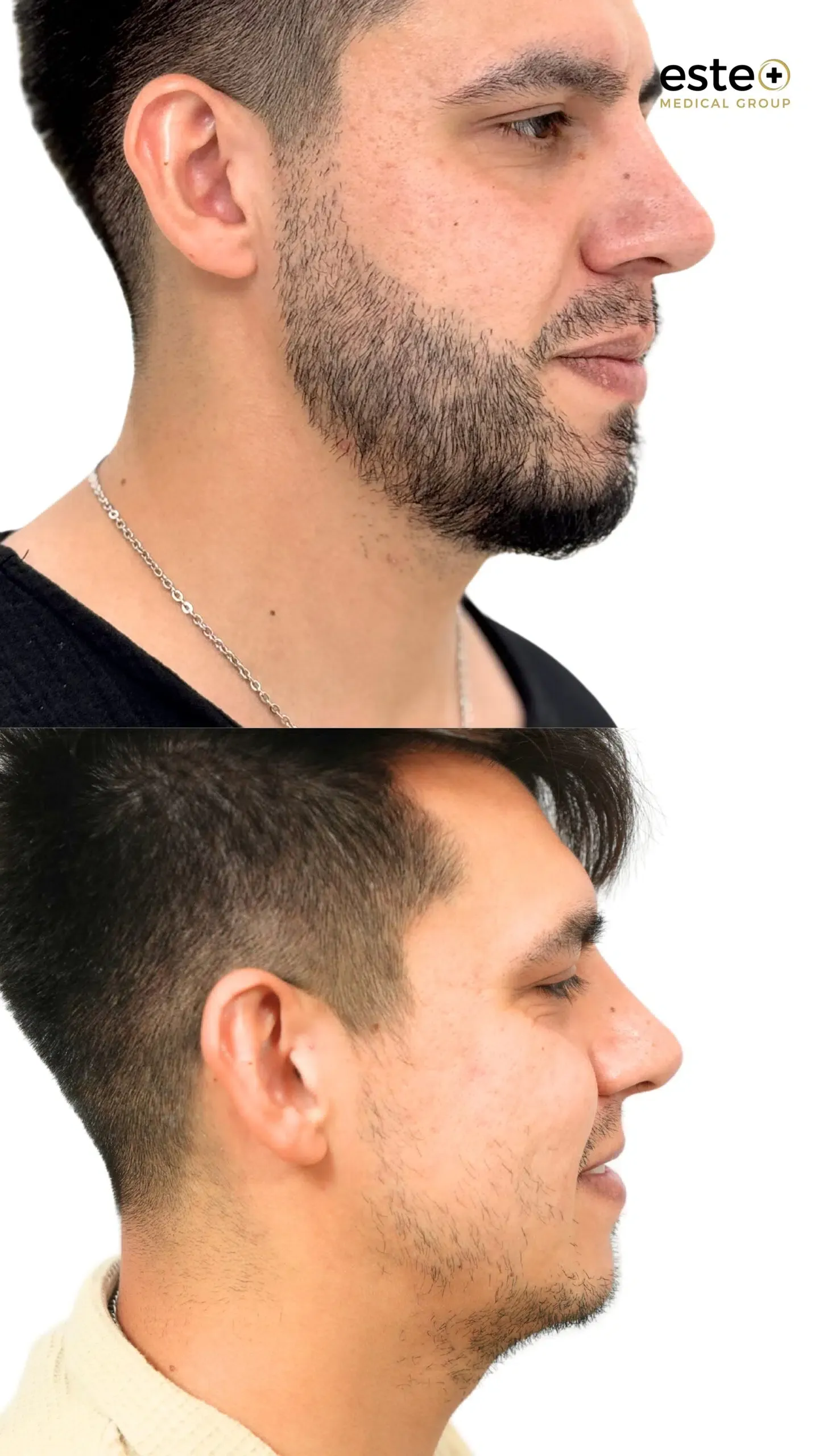 Hair transplant before and after results (visible regrowth)